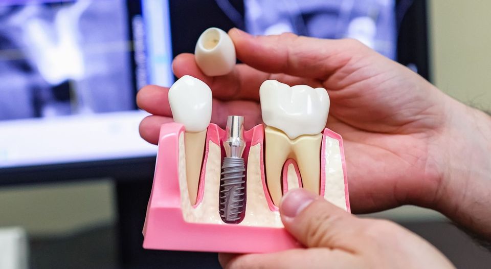 Имплантация